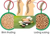 Cost-Effectiveness of Alendronate and Zoledronate for Osteoporosis Treament
